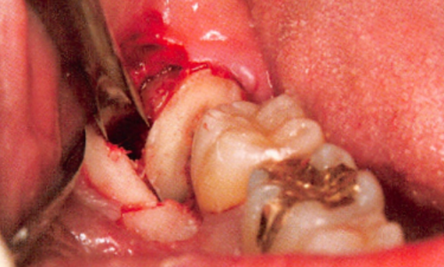 用这种药,拔牙要小心?