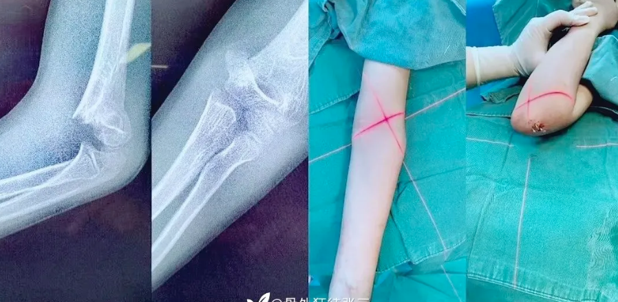 儿童髁上骨折“零切开”合集