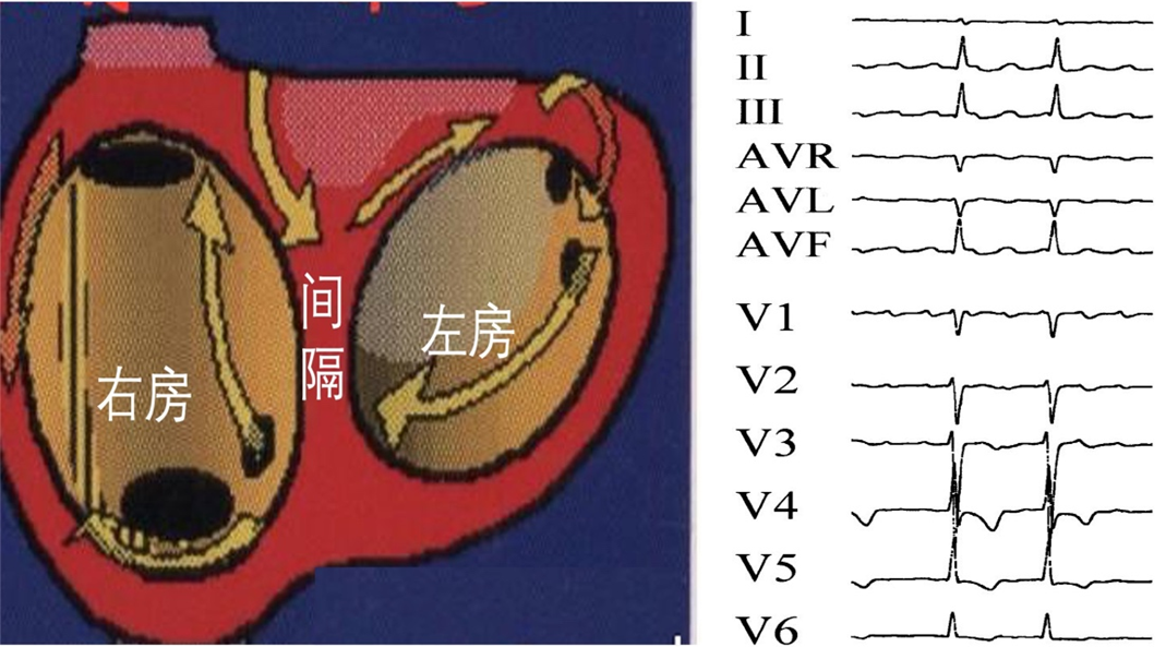 一文总结：9种心房扑动机制及心电图表现！