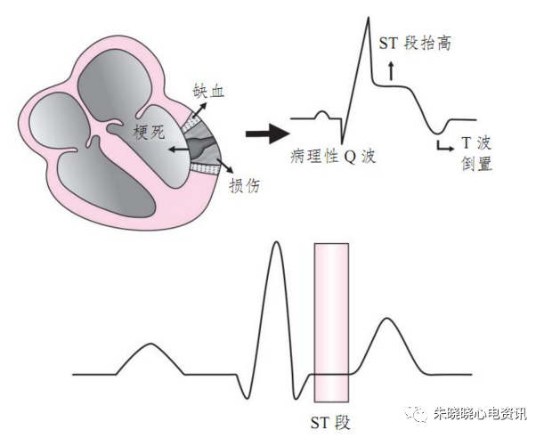 心梗时快速判断梗死部位和范围！