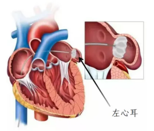 抗凝治疗受限？出血风险高？这份LAAC共识为房颤患者打开“安全通道”！