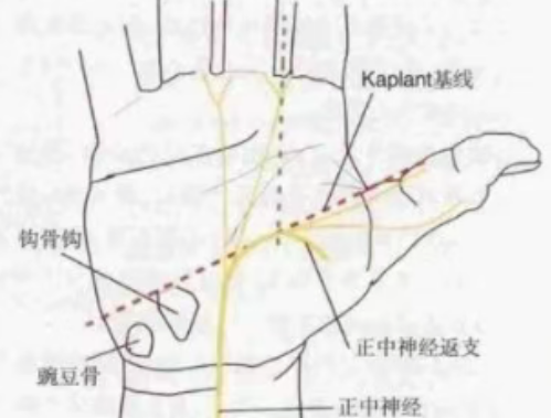 微创掌侧小切口治疗腕管综合征
