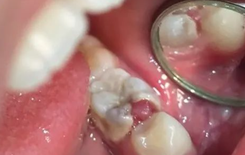 牙髓息肉的处理方法