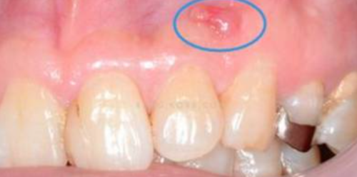 瘘管治疗的灵活处理