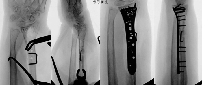 “骑缝钉”辅助固定骨折：锦上添花还是画蛇添足？