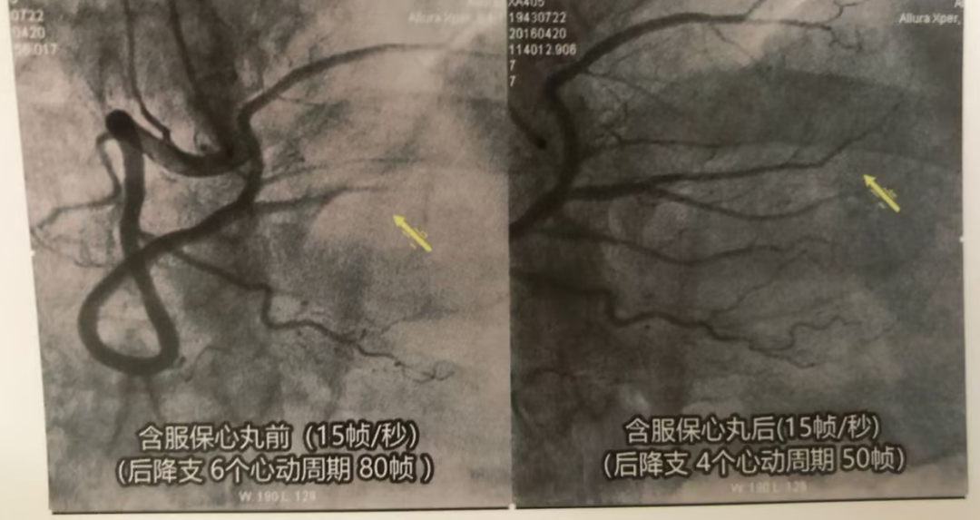 支架搞不定的心肌缺血，这个方法却能有效应对