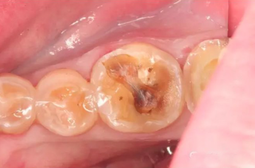 急性牙髓炎的诊断要点和急诊处理方法