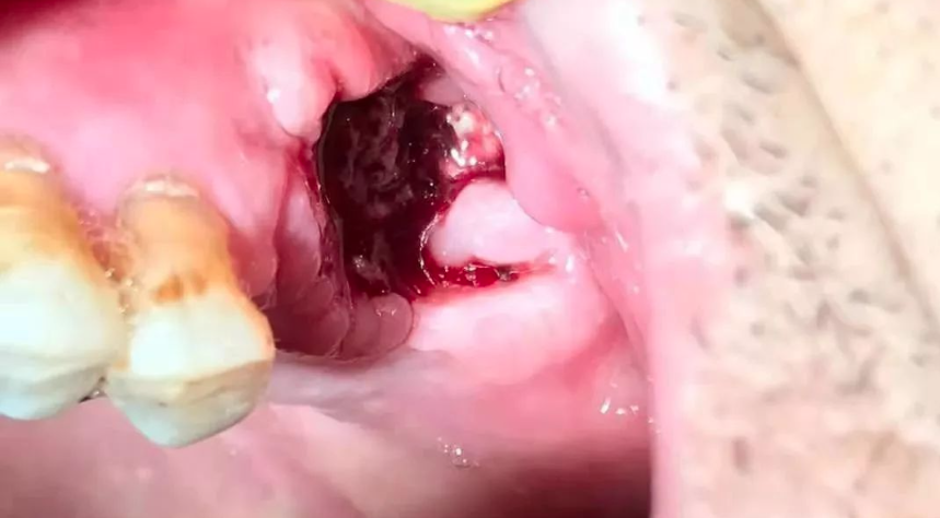 忽视这个“冷门”拔牙禁忌症，风险不容小视！