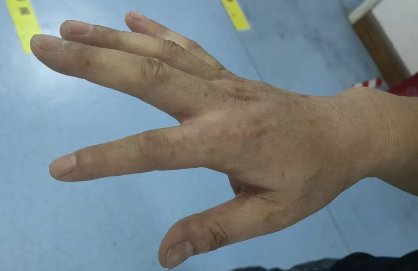 罕见病：掌指关节绞索