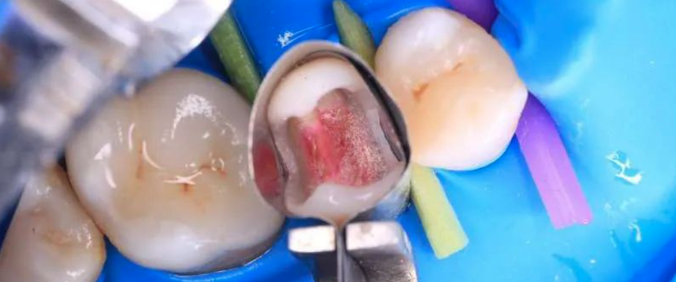 龈壁提升术：技术要点与临床争议全解析