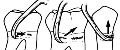 不得不知的治疗牙周炎的5种最有效方法!