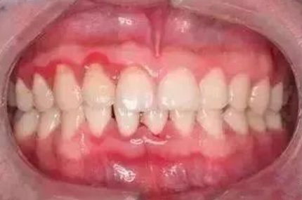 牙龈出现白脓包,该怎么处理