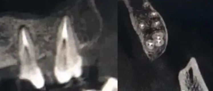 提高根管预备成功率的几个关键点