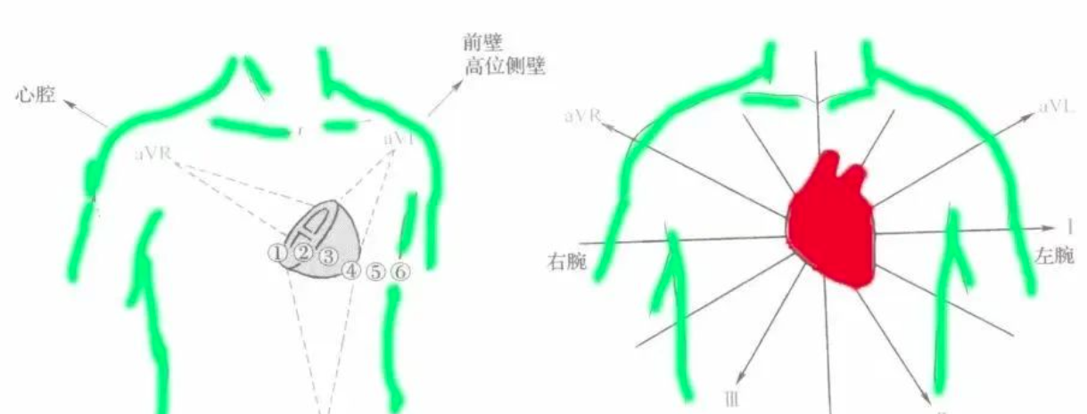 一文系统化学习--前壁心肌梗死定位、命名和诊断