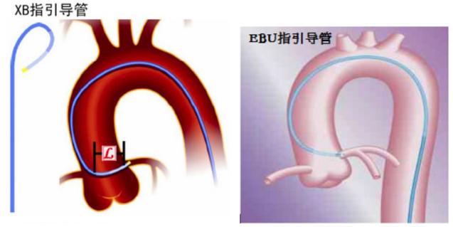 冠脉介入先利器——关于指引导管的那些事儿