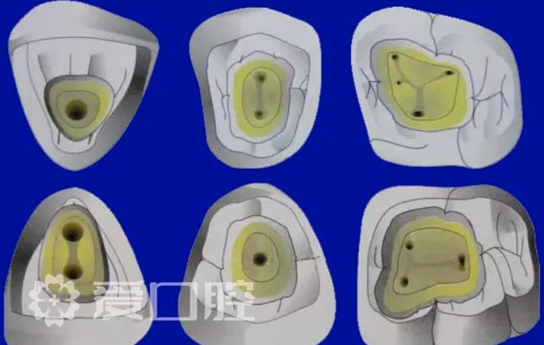 根管治疗应该注意的细节总结