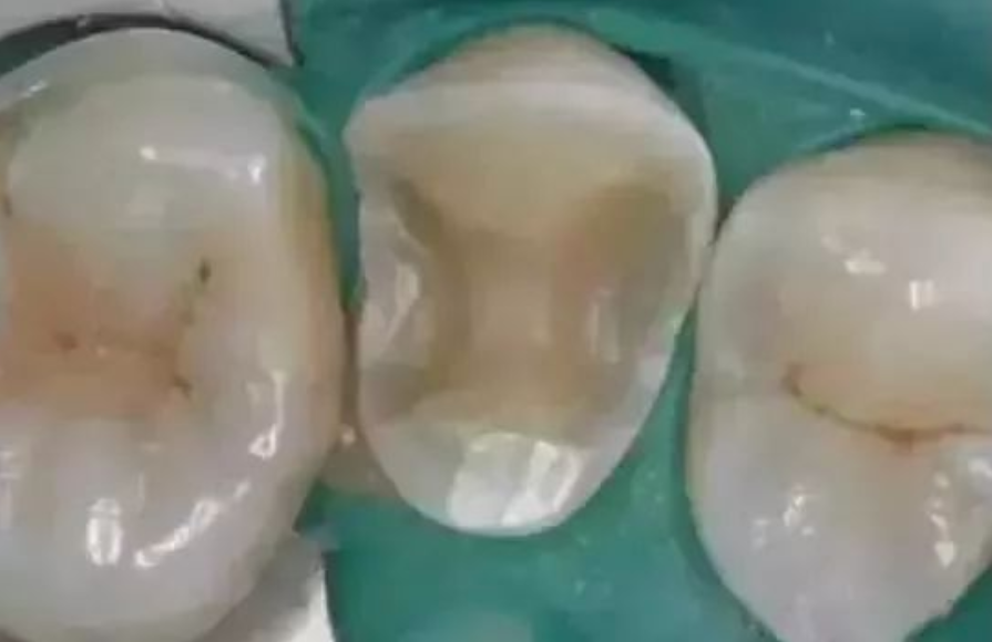 如何把握嵌体与高嵌体？