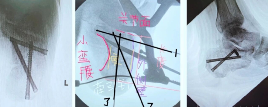 AO儿童骨折治疗原则，高清美图欣赏