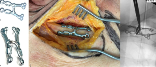巧用 “低切迹双平面” 钢板内固定治疗锁骨内侧端骨折