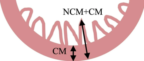 心肌致密化不全:诊断过时,还是过度了?