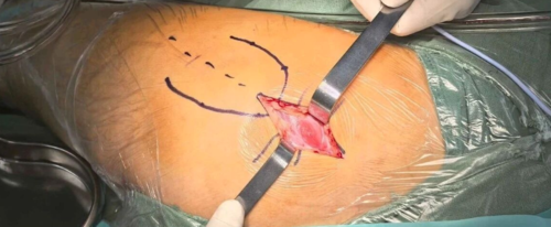 SuperPATH微创全髋关节置换手术入路图解