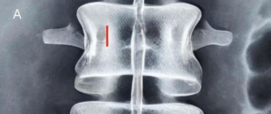 单侧双通道内镜手术(UBE)入门：初学者技术概述