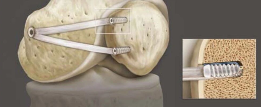 手术技术 | 内侧髌股韧带重建手术步骤