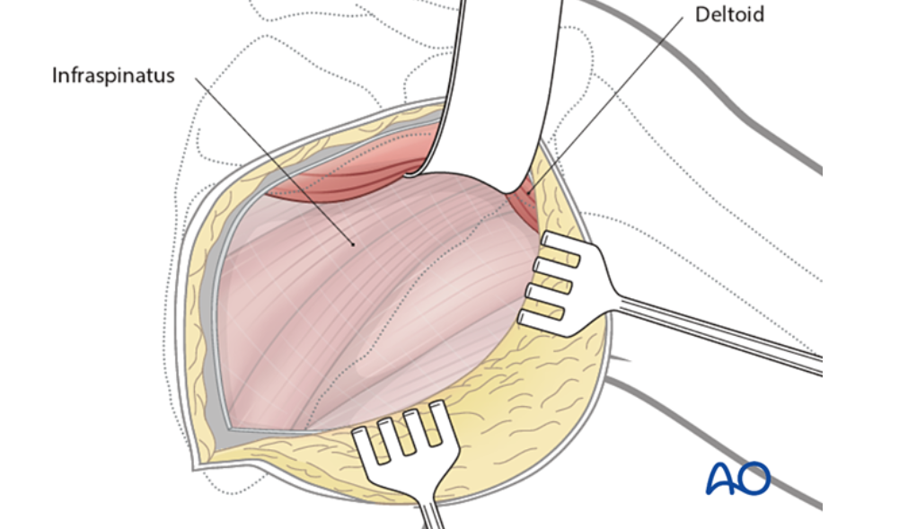 肩胛骨手术标准入路全解析：从解剖到操作的实战指南