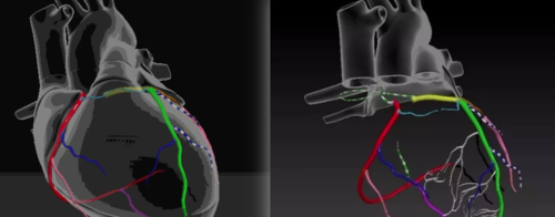 图解心电图!定位心梗犯罪血管