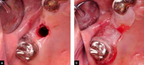 拔牙导致上颌窦穿孔的应对策略