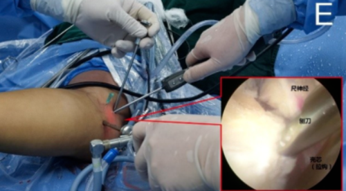 肘关节镜下“精准清理”治疗顽固性肱骨内上髁炎