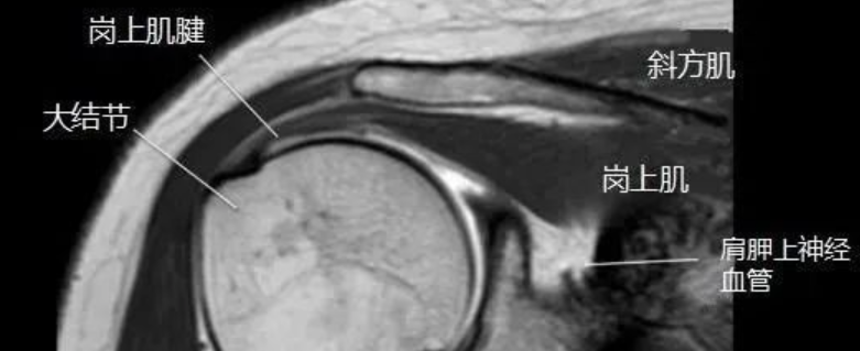 肩关节磁共振（MRI）经典解剖