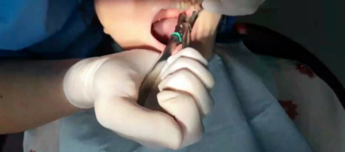 “八” 字扭转拔牙法的创新应用