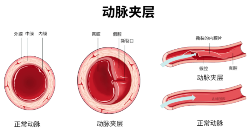 肌钙蛋白升高不要只想到心梗，还有8种情况不可忽略