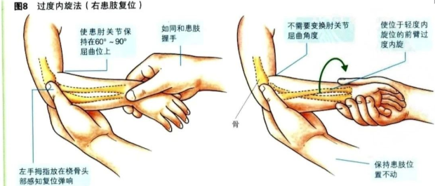 科普篇：一图了解如何在家里自己复位小儿桡骨小头半脱位“牵拉肘”！