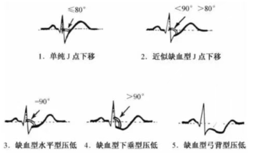 一文道尽『ST-T改变』的种种困惑!