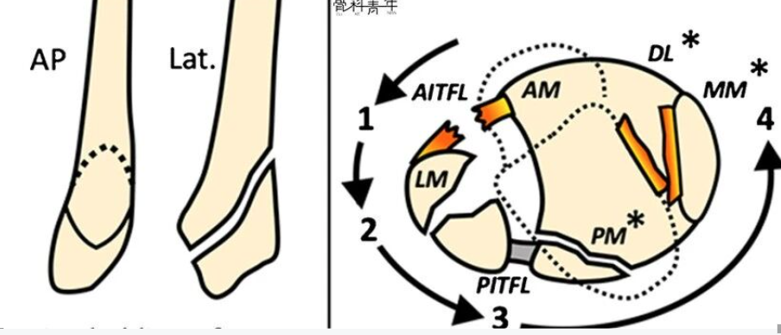  “损伤环”理念：踝关节骨折的损伤推断
