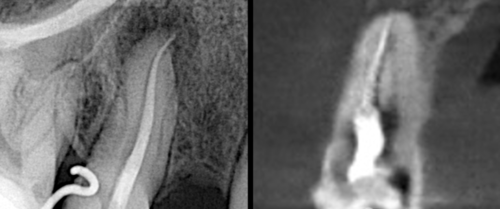 15慢性根尖周炎显微根管再治疗1例