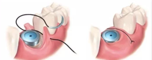 种植手术中部分缝合归纳