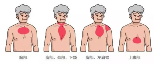 三甲规培教案:急性心肌梗死的临床大全