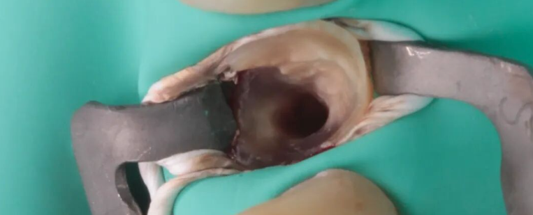  看个马里兰桥修复，感觉好复杂