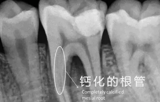 门诊遇到钙化根管怎么处理？这三个技巧一定要知道！