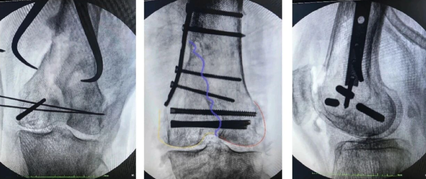 跟着AO做股骨内髁
