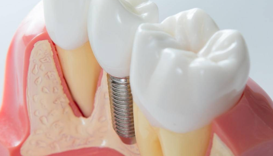 种植术后神经损伤怎么办？（下颌神经）不要只会用甲钴胺