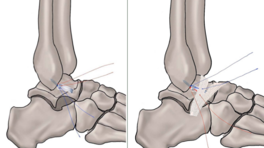 一文掌握：慢性踝关节外侧不稳的诊治要点