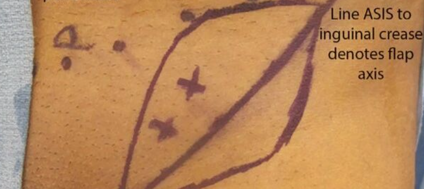 旋髂浅动脉穿支皮瓣的术前标记及切取