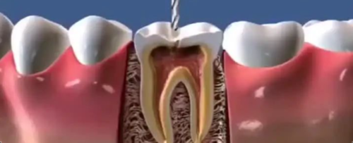 根管不做冠,早晚是后患!患者“不做冠”后牙齿劈成了两半
