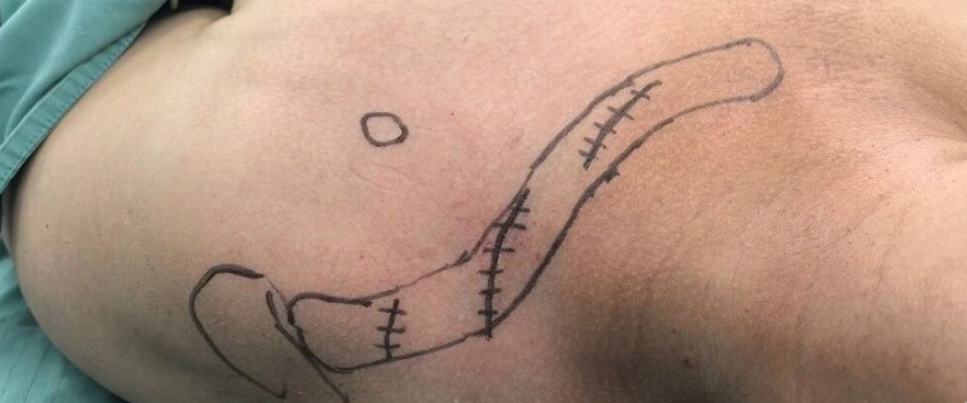两种锁骨中段粉碎性骨折微创钢板内固定术手术技巧