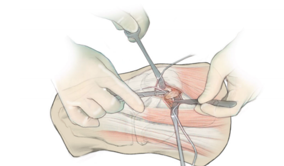 髌骨脱位怎么办？骨科医生详解MPFL重建方案