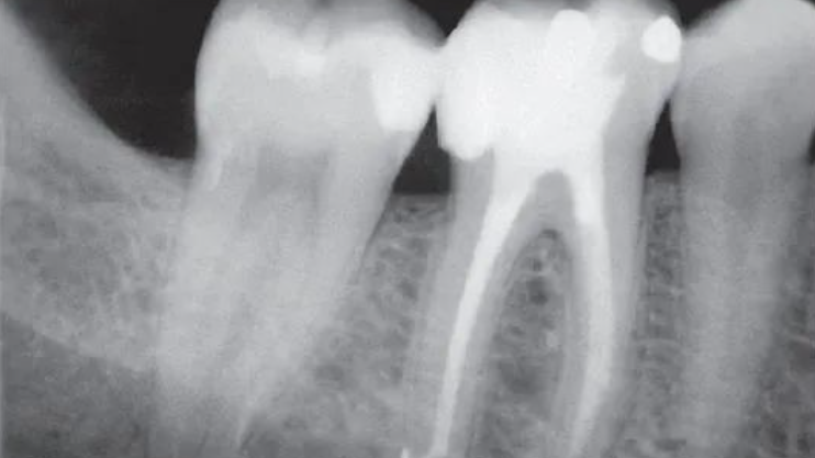 急性牙髓炎根尖周炎的应急处理，其实并没有那么简单